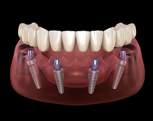 Dentures