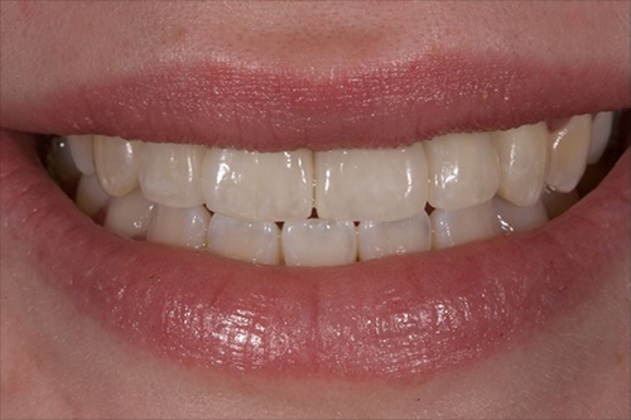Dental Implants after