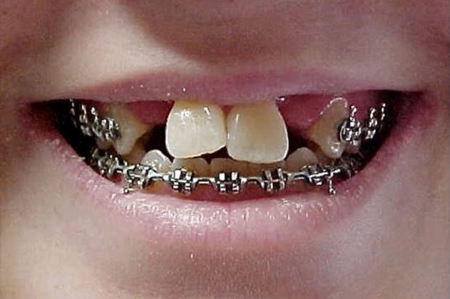 Dental implants before
